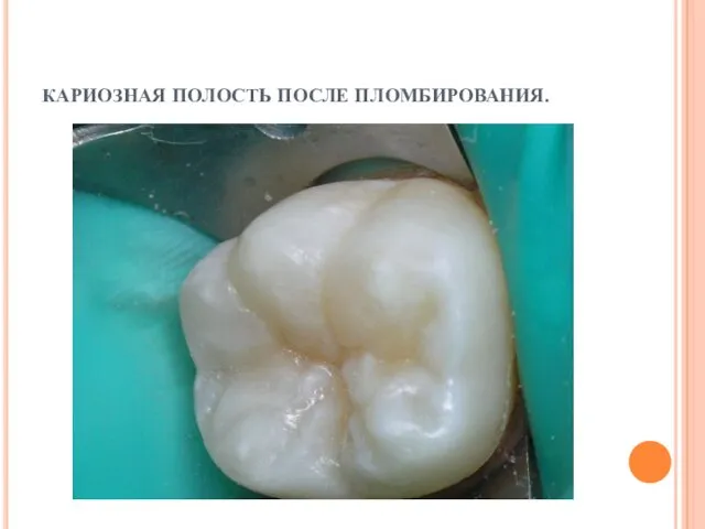 КАРИОЗНАЯ ПОЛОСТЬ ПОСЛЕ ПЛОМБИРОВАНИЯ.