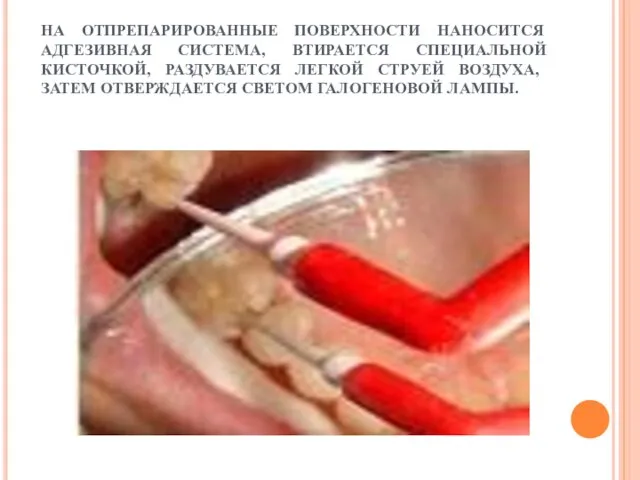 НА ОТПРЕПАРИРОВАННЫЕ ПОВЕРХНОСТИ НАНОСИТСЯ АДГЕЗИВНАЯ СИСТЕМА, ВТИРАЕТСЯ СПЕЦИАЛЬНОЙ КИСТОЧКОЙ, РАЗДУВАЕТСЯ ЛЕГКОЙ СТРУЕЙ ВОЗДУХА,