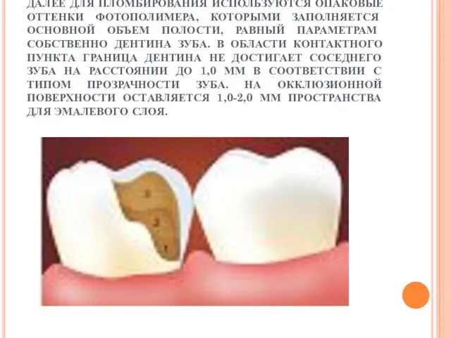 ДАЛЕЕ ДЛЯ ПЛОМБИРОВАНИЯ ИСПОЛЬЗУЮТСЯ ОПАКОВЫЕ ОТТЕНКИ ФОТОПОЛИМЕРА, КОТОРЫМИ ЗАПОЛНЯЕТСЯ ОСНОВНОЙ ОБЪЕМ ПОЛОСТИ, РАВНЫЙ