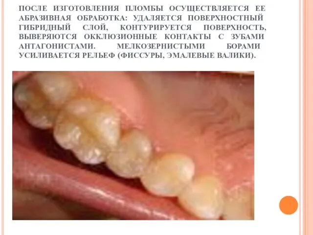 ПОСЛЕ ИЗГОТОВЛЕНИЯ ПЛОМБЫ ОСУЩЕСТВЛЯЕТСЯ ЕЕ АБРАЗИВНАЯ ОБРАБОТКА: УДАЛЯЕТСЯ ПОВЕРХНОСТНЫЙ ГИБРИДНЫЙ СЛОЙ, КОНТУРИРУЕТСЯ ПОВЕРХНОСТЬ,
