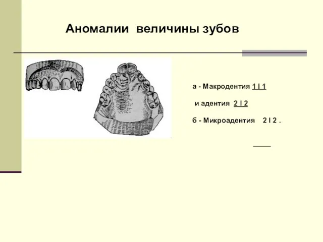 Аномалии величины зубов а - Макродентия 1 І 1 и