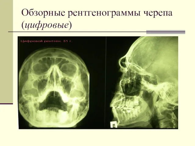 Обзорные рентгенограммы черепа (цифровые)