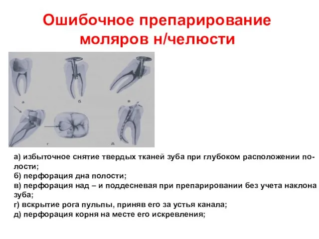 Ошибочное препарирование моляров н/челюсти а) избыточное снятие твердых тканей зуба