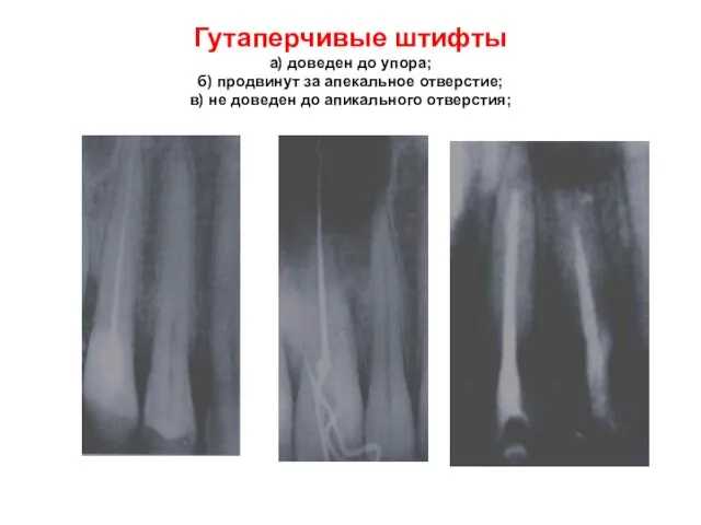 Гутаперчивые штифты а) доведен до упора; б) продвинут за апекальное