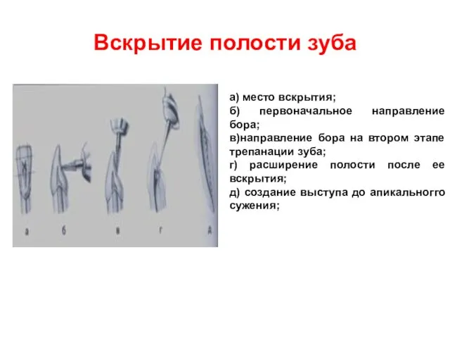 Вскрытие полости зуба а) место вскрытия; б) первоначальное направление бора;