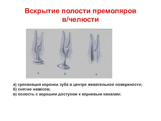 Вскрытие полости премоляров в/челюсти а) трепанация коронки зуба в центре