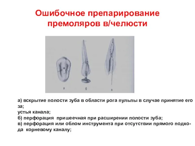 Ошибочное препарирование премоляров в/челюсти а) вскрытие полости зуба в области