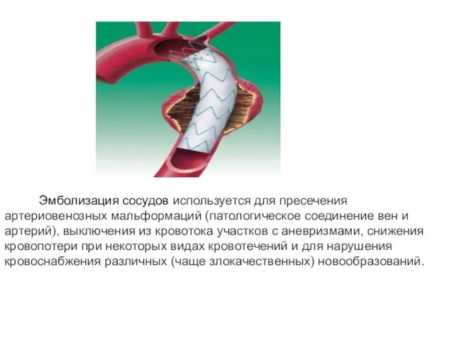 Эмболизация сосудов используется для пресечения артериовенозных мальформаций (патологическое соединение вен и артерий), выключения