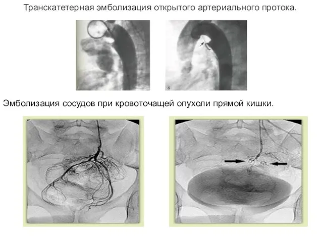 Транскатетерная эмболизация открытого артериального протока. Эмболизация сосудов при кровоточащей опухоли прямой кишки.