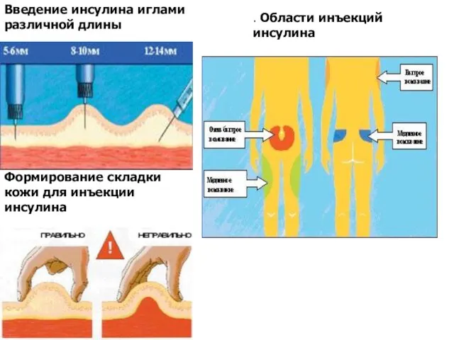 Введение инсулина иглами различной длины Формирование складки кожи для инъекции инсулина . Области инъекций инсулина