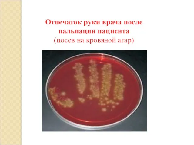 Отпечаток руки врача после пальпации пациента (посев на кровяной агар)