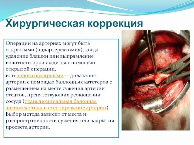 Хирургическая коррекция Операции на артериях могут быть открытыми (эндартеректомия), когда