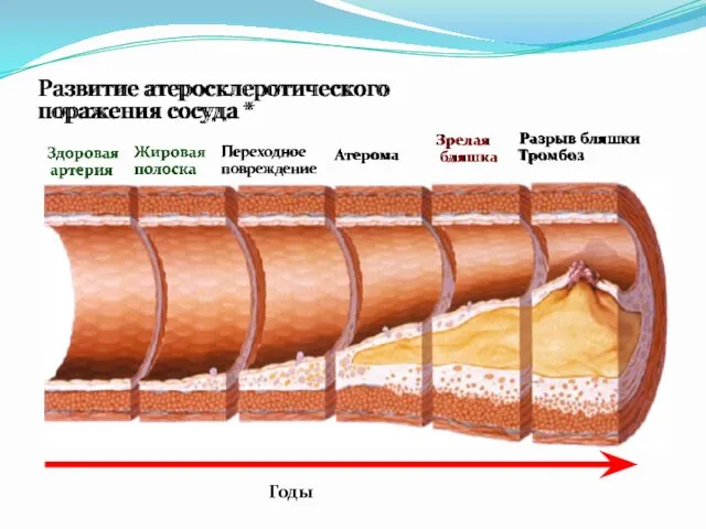 Развитие атеросклеротического поражения сосуда * Здоровая артерия Жировая полоска Переходное
