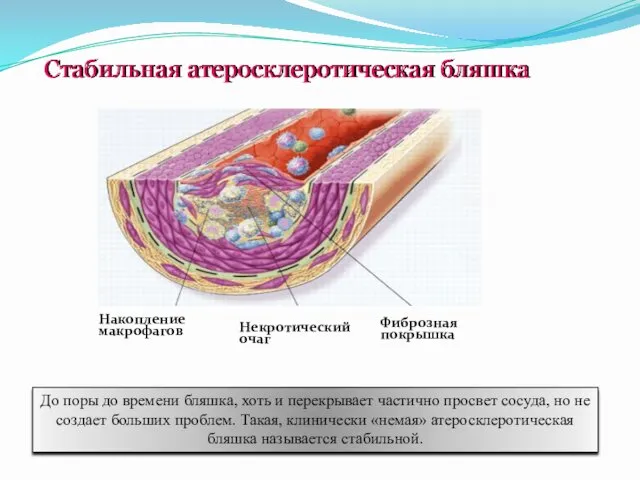 Стабильная атеросклеротическая бляшка Накопление макрофагов Некротический очаг Фиброзная покрышка До