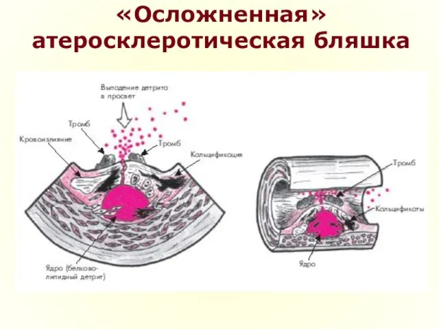 «Осложненная» атеросклеротическая бляшка