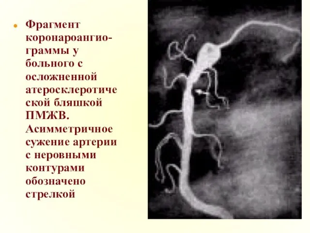 Фрагмент коронароангио-граммы у больного с осложненной атеросклеротической бляшкой ПМЖВ. Асимметричное