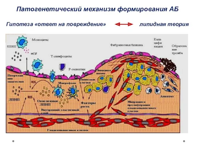 Патогенетический механизм формирования АБ Гипотеза «ответ на повреждение» липидная теория