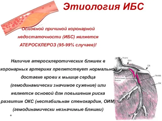 Основной причиной коронарной недостаточности (ИБС) является АТЕРОСКЛЕРОЗ (95-99% случаев)! Наличие