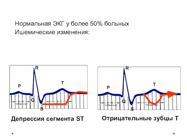 Нормальная ЭКГ у более 50% больных Ишемические изменения: P Q