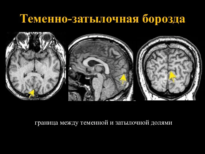 Теменно-затылочная борозда граница между теменной и затылочной долями