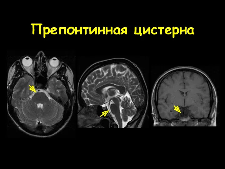 Препонтинная цистерна