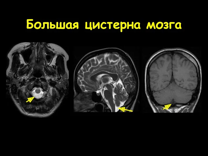 Большая цистерна мозга