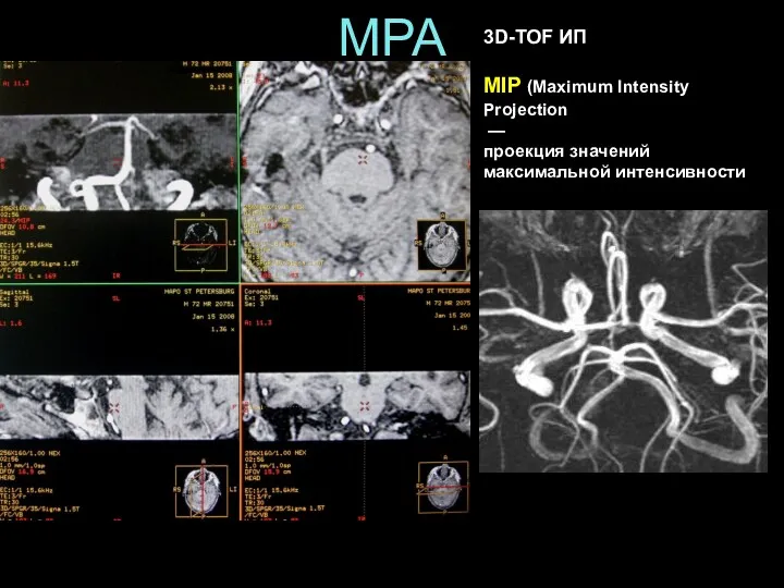 МРА 3D-TOF ИП MIP (Maximum Intensity Projection — проекция значений максимальной интенсивности