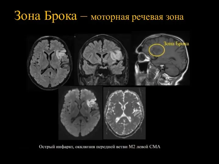 Зона Брока – моторная речевая зона