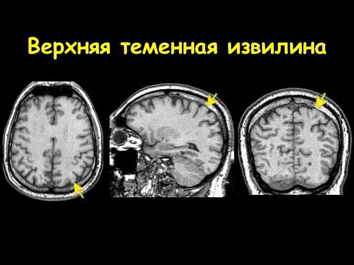 Верхняя теменная извилина