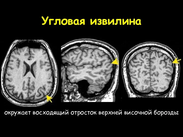 Угловая извилина окружает восходящий отросток верхней височной борозды