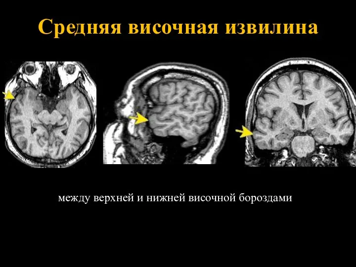 Средняя височная извилина между верхней и нижней височной бороздами