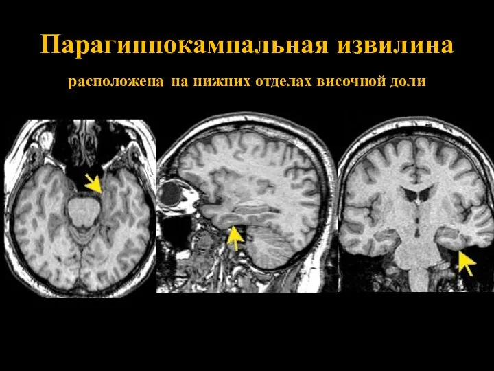 Парагиппокампальная извилина расположена на нижних отделах височной доли