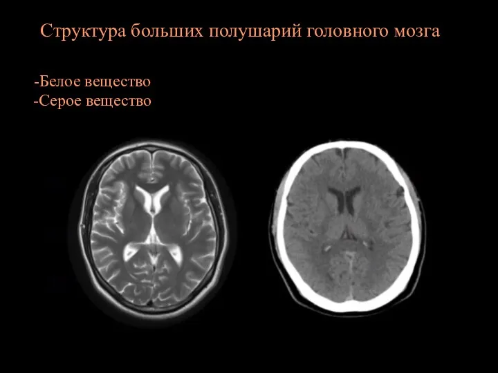 Структура больших полушарий головного мозга Белое вещество Серое вещество