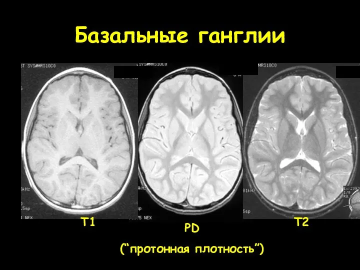 Базальные ганглии T1 PD (“протонная плотность”) T2