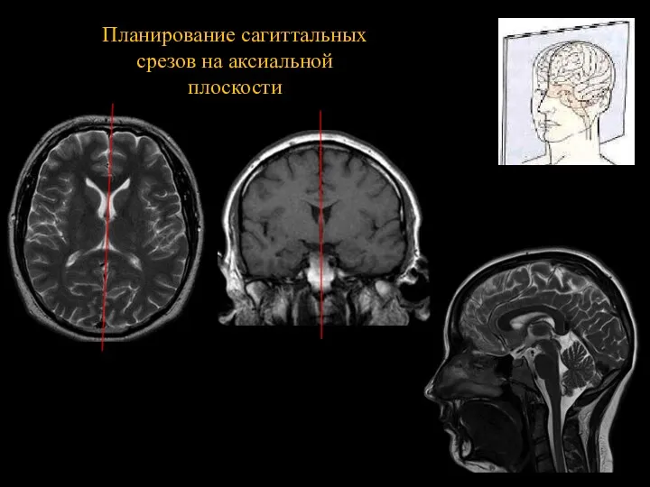 Планирование сагиттальных срезов на аксиальной плоскости