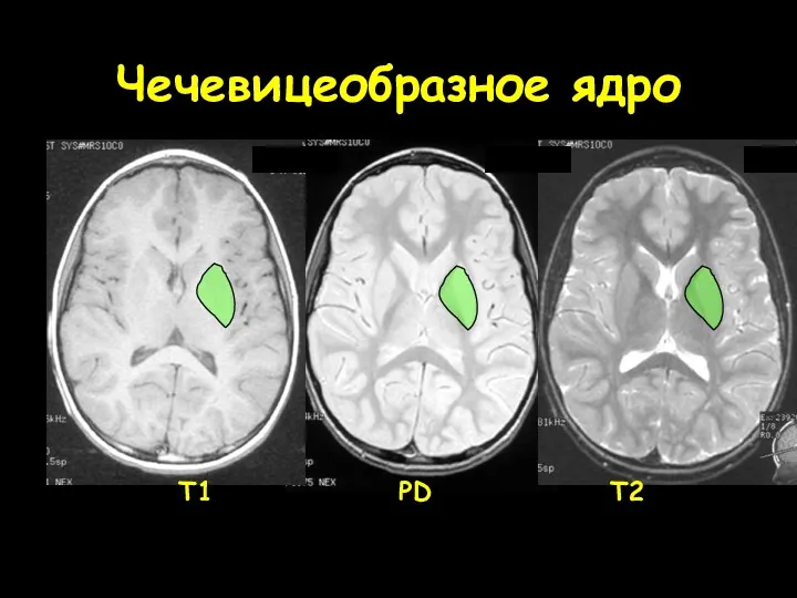 Чечевицеобразное ядро T1 PD T2