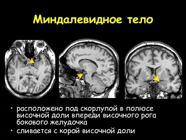 Миндалевидное тело расположено под скорлупой в полюсе височной доли впереди