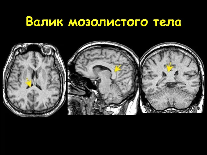 Валик мозолистого тела