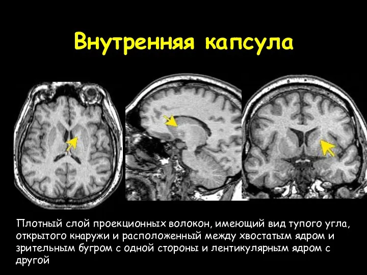 Внутренняя капсула Плотный слой проекционных волокон, имеющий вид тупого угла,