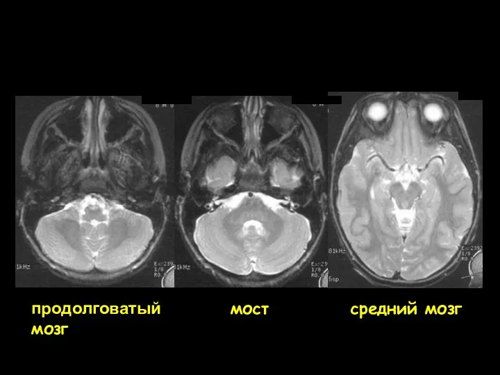 продолговатый мозг мост средний мозг