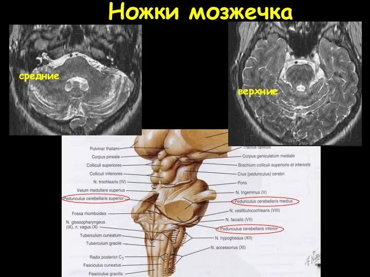 Ножки мозжечка средние верхние