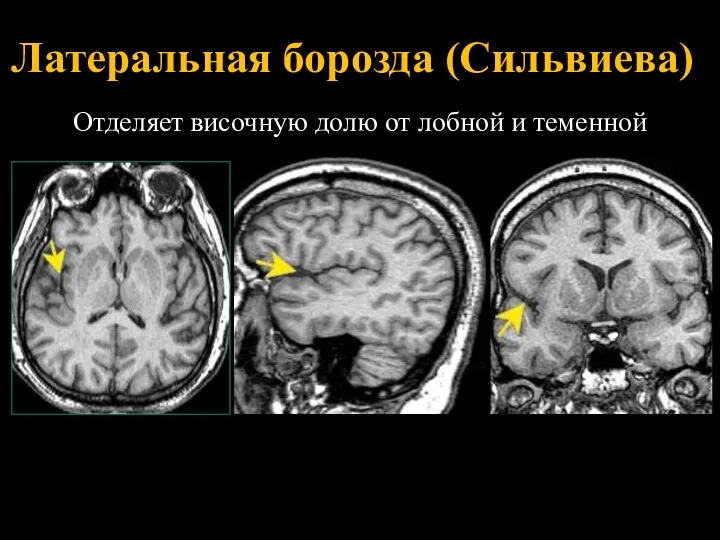 Латеральная борозда (Сильвиева) Отделяет височную долю от лобной и теменной