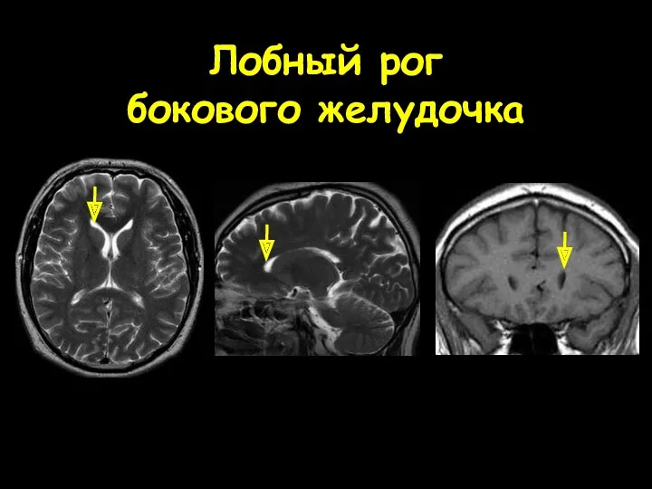 Лобный рог бокового желудочка