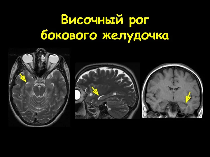 Височный рог бокового желудочка