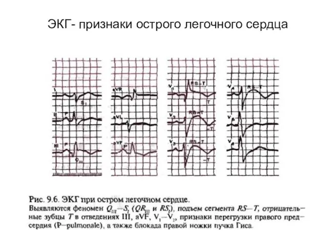 ЭКГ- признаки острого легочного сердца