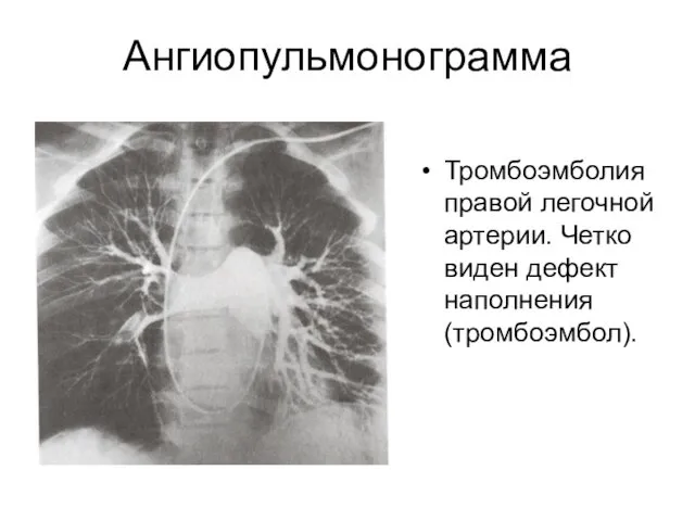Ангиопульмонограмма Тромбоэмболия правой легочной артерии. Четко виден дефект наполнения (тромбоэмбол).