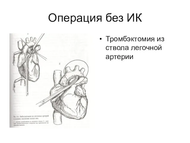 Операция без ИК Тромбэктомия из ствола легочной артерии