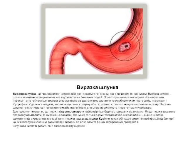 Виразка шлунка Виразка шлунка - це пошкодження шлунка або дванадцятипалої