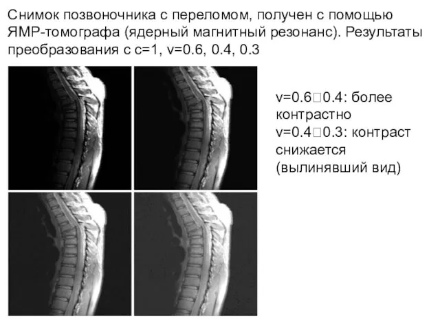 Снимок позвоночника с переломом, получен с помощью ЯМР-томографа (ядерный магнитный