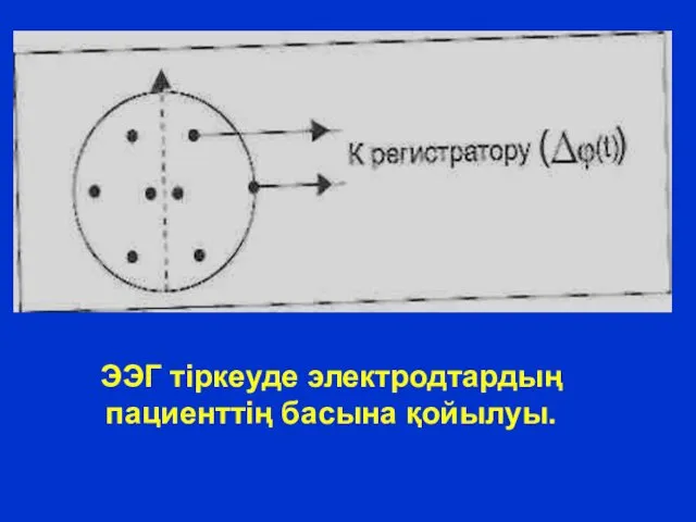 ЭЭГ тіркеуде электродтардың пациенттің басына қойылуы.